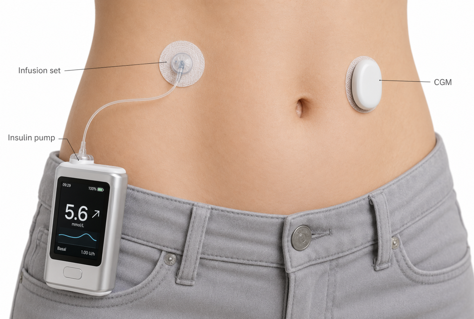 Illustration of insulin pump and CGM device in AID system